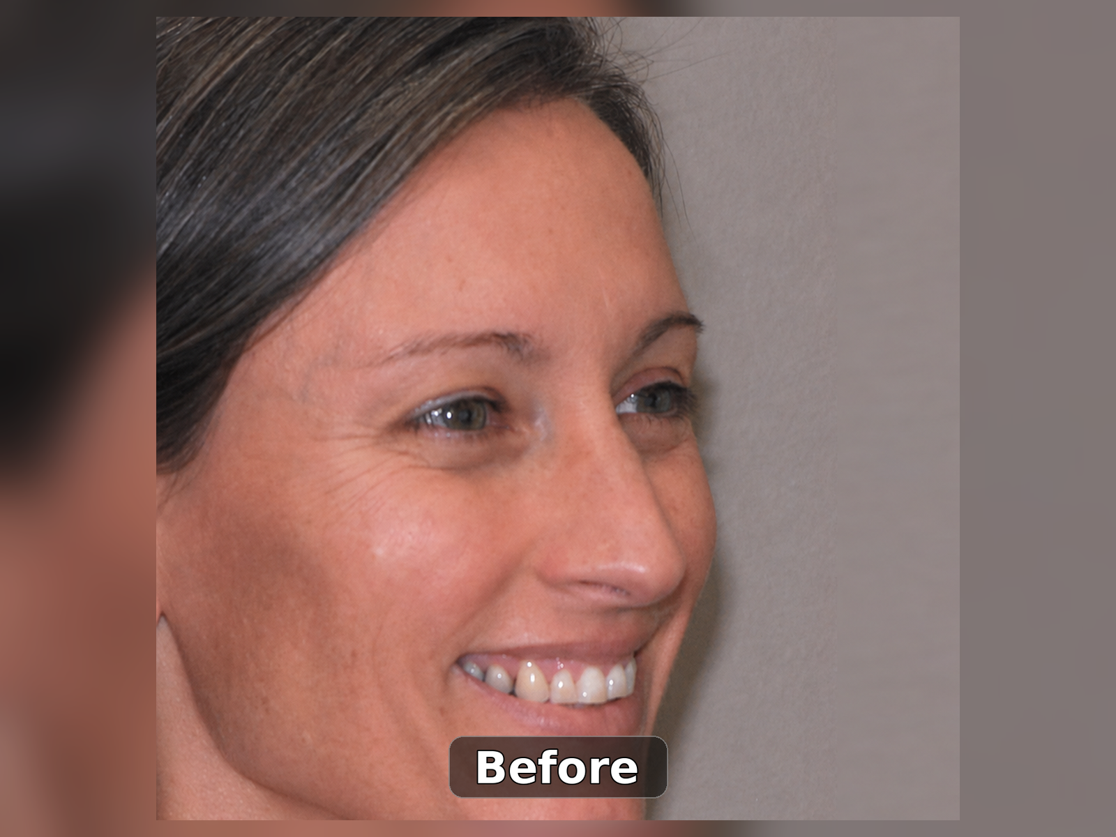 Before smile transformation case 10