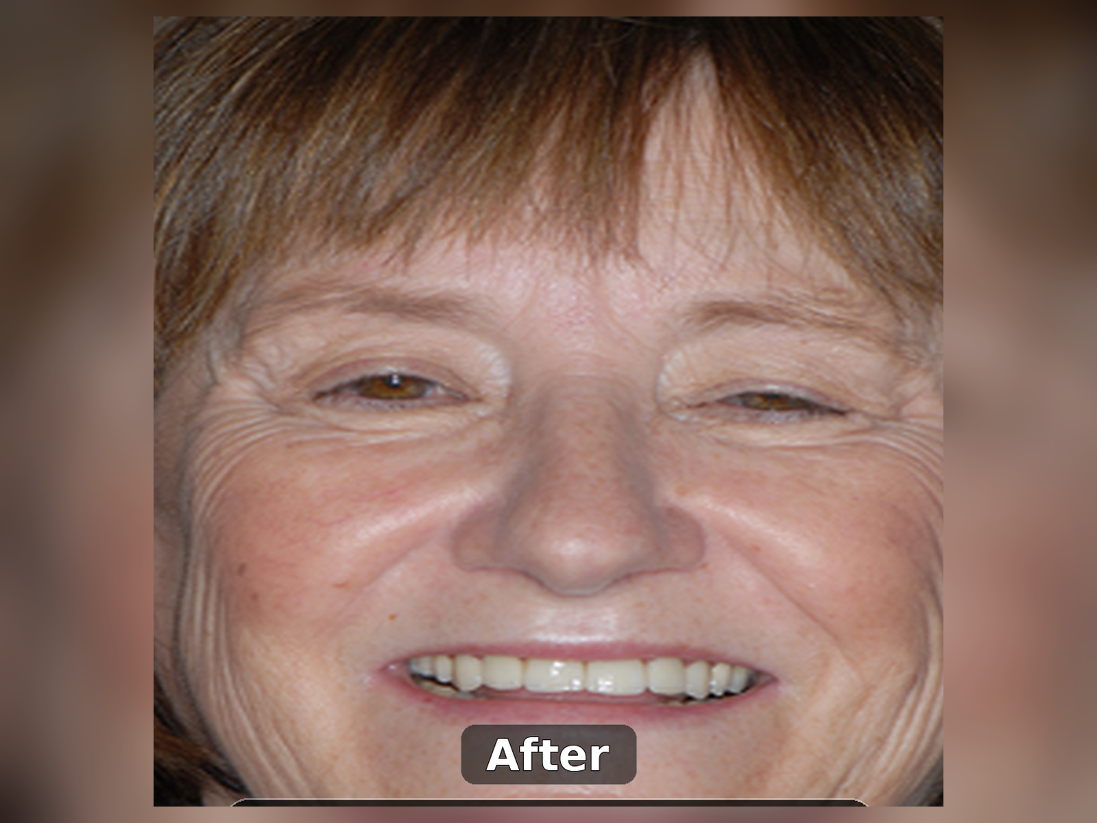 After smile transformation case 3
