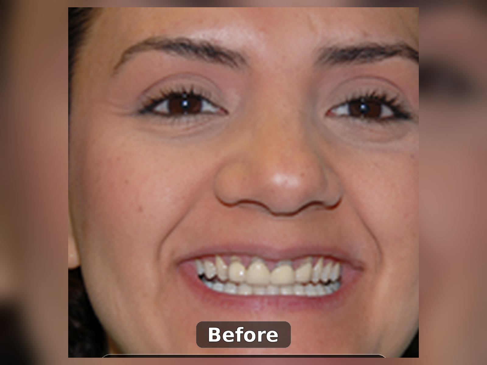 Before smile transformation case 7