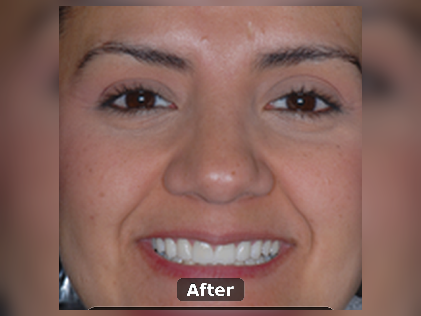 After smile transformation case 7