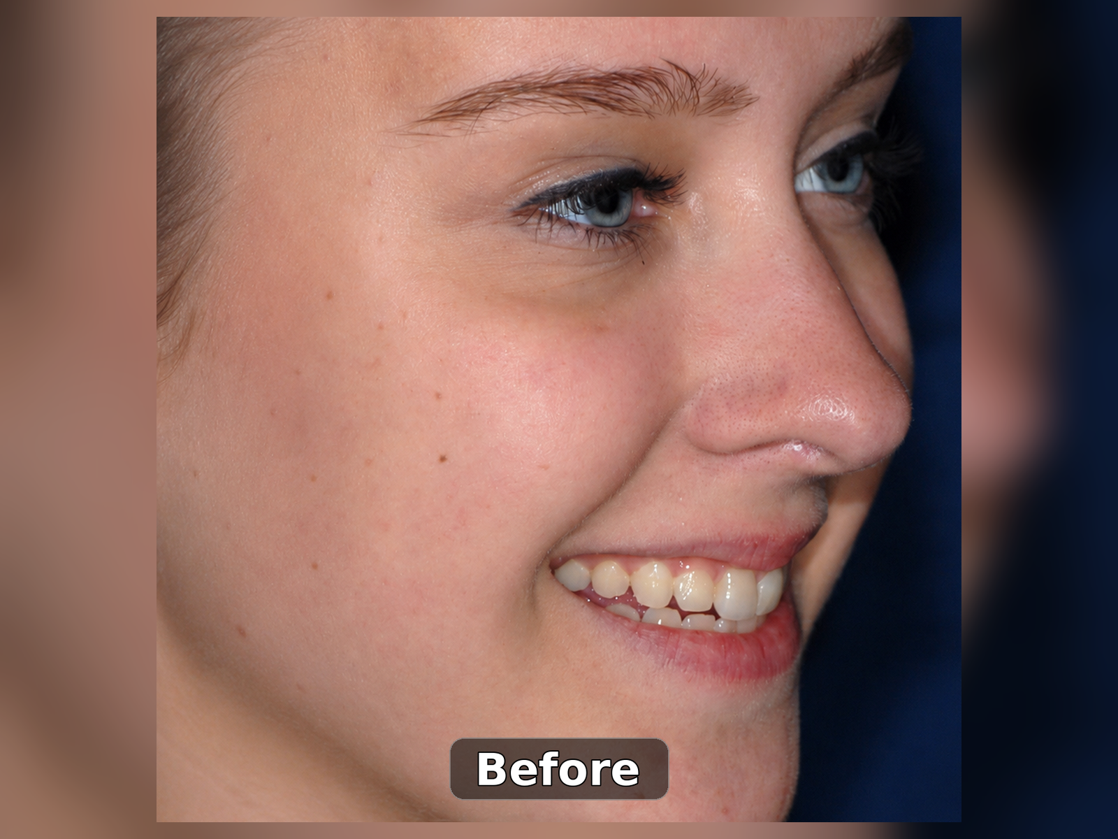 Before smile transformation case 8
