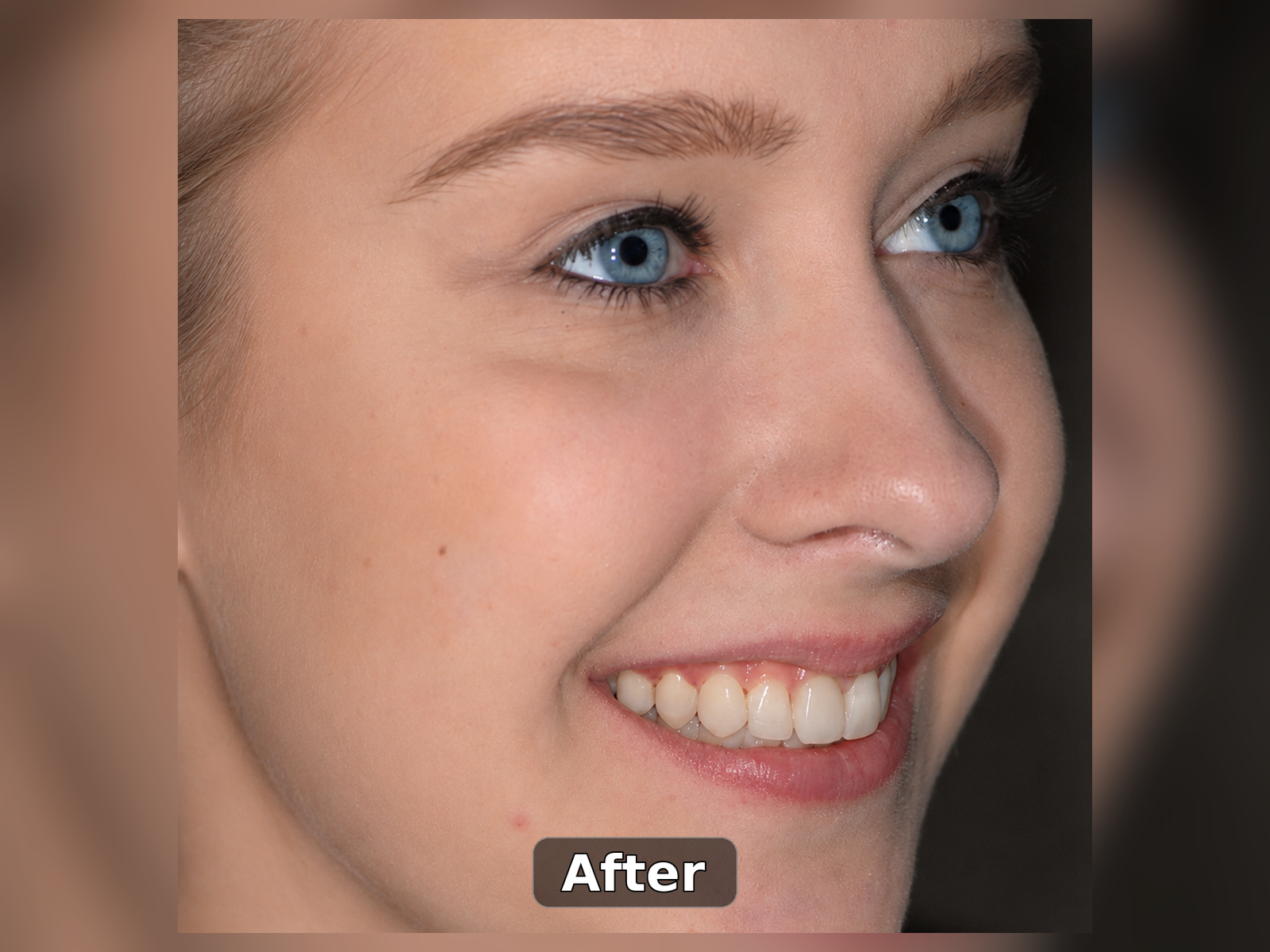 After smile transformation case 8