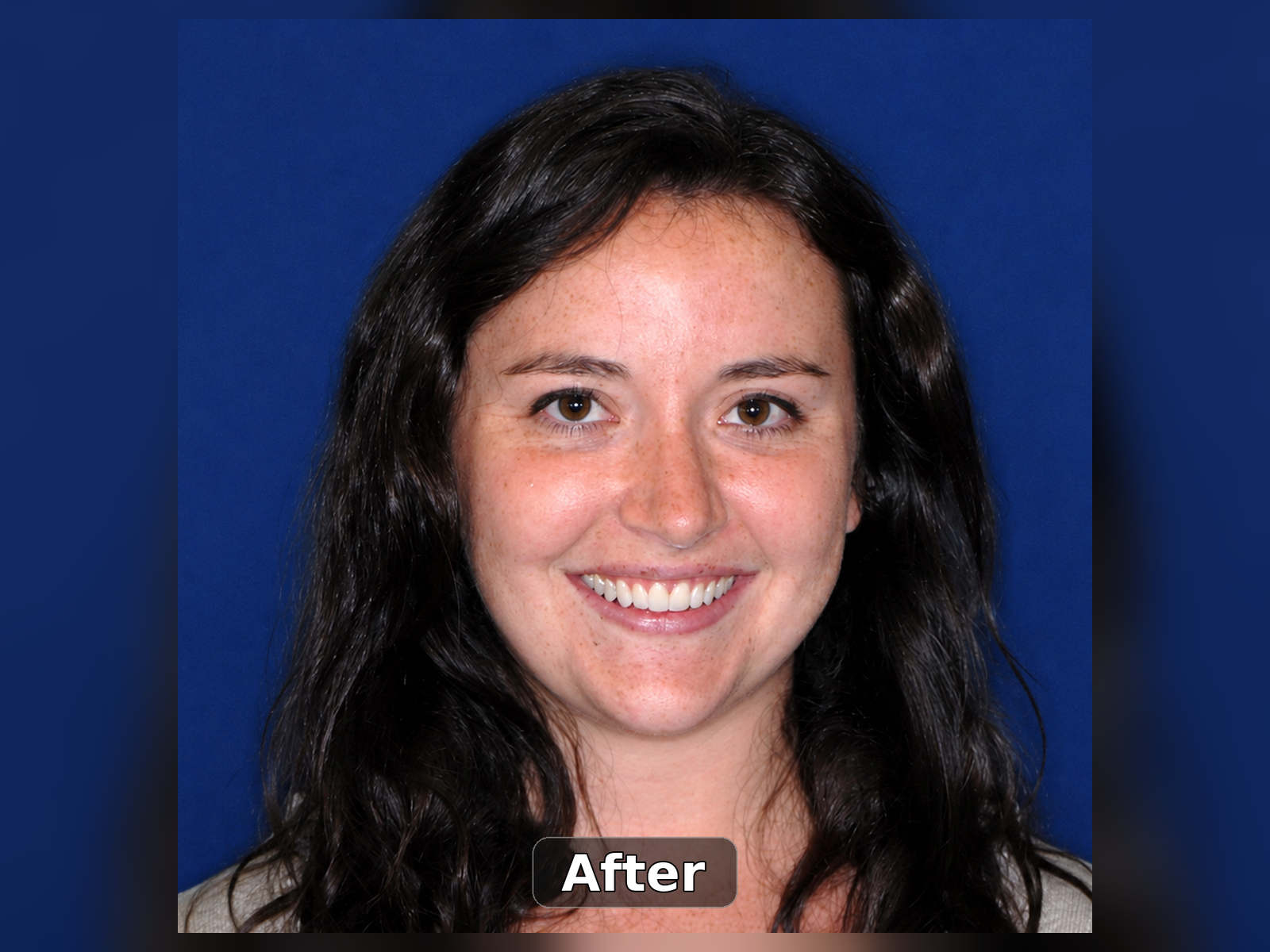 After smile transformation case 9