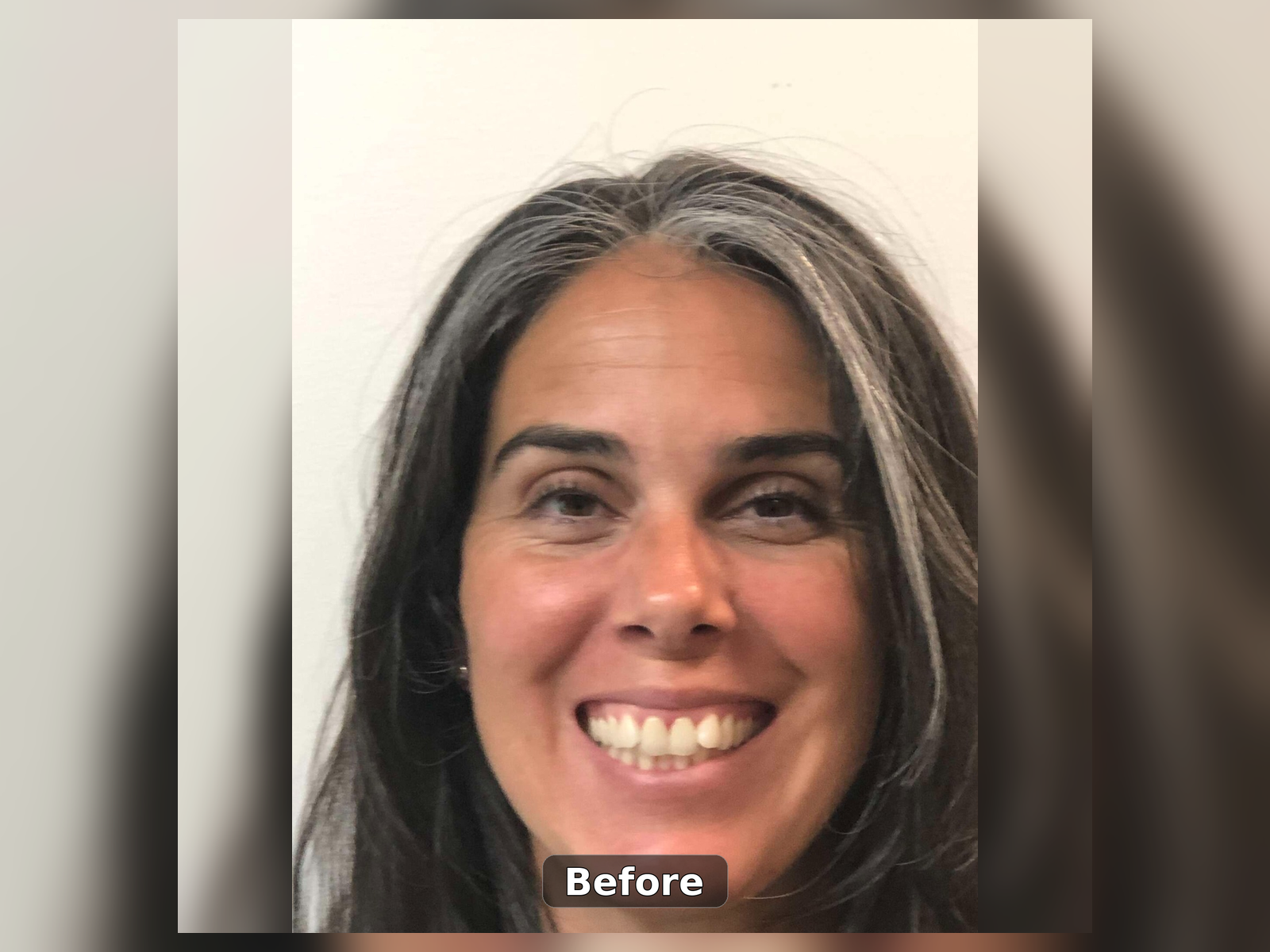 Before Invisalign smile transformation
