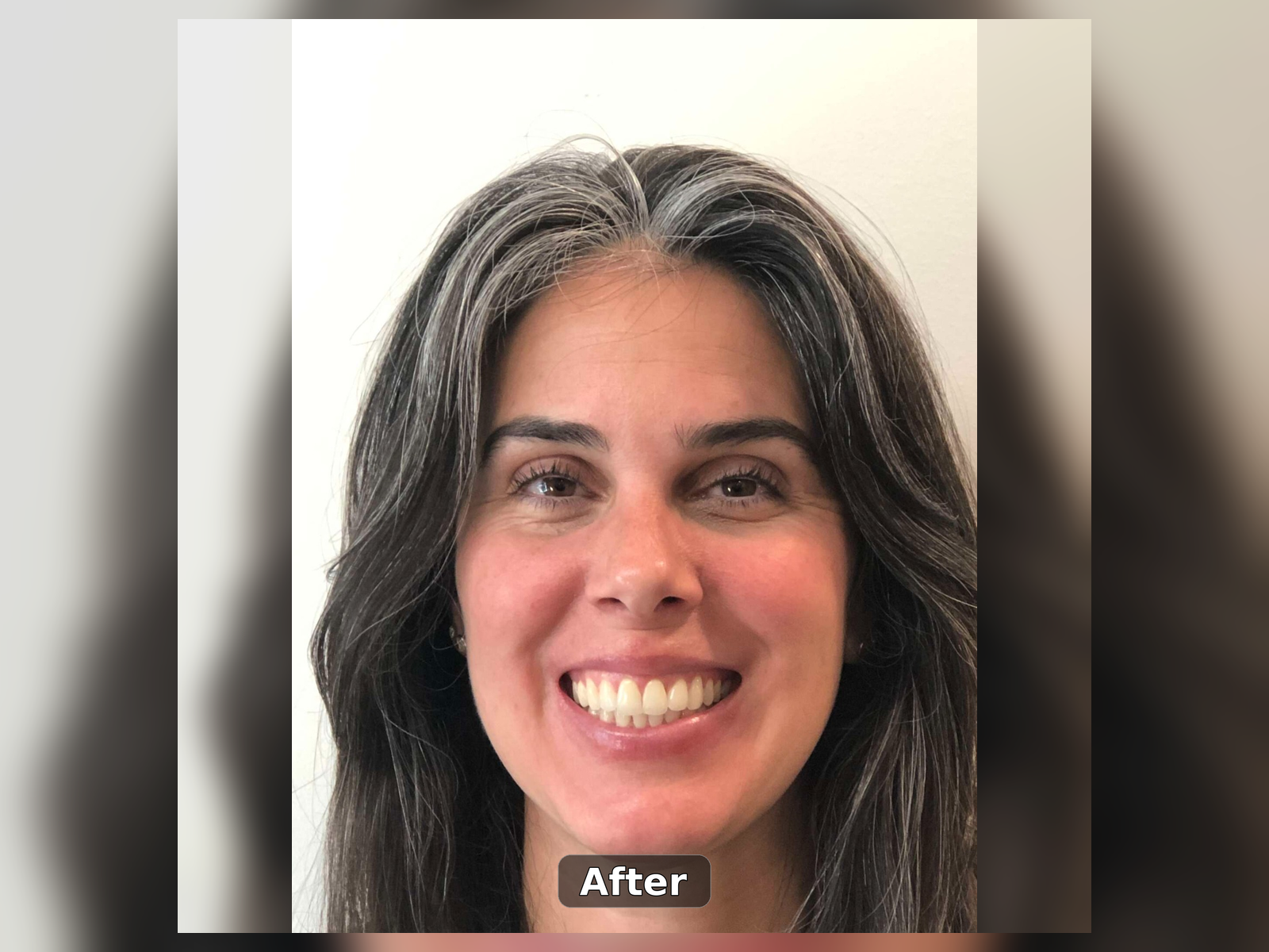After Invisalign smile transformation
