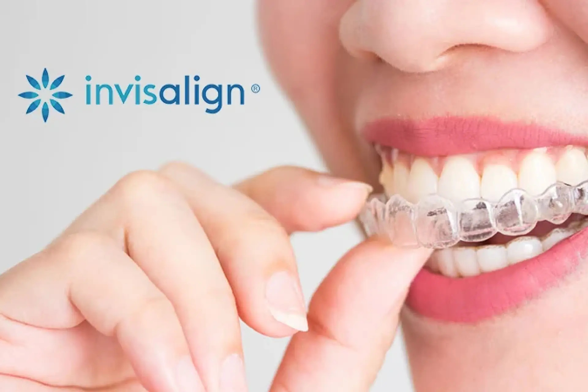 Clear aligners at Babcock Holistic Dentistry